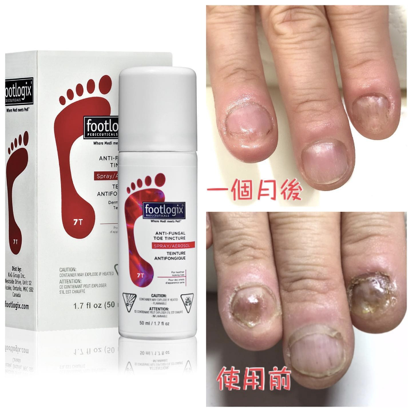 加拿大 Footlogix  7T 灰甲寶 50ml  [行貨］